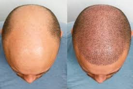 The Ultimate Guide to Hair Transplant in Dubai: What You Need to Know