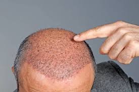What Are The Ins And Outs Of Hair Transplants?